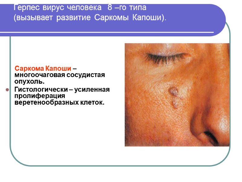 Герпес вирус человека  8 –го типа  (вызывает развитие Саркомы Капоши).  